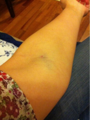 propp i armvecket propp i armvecket