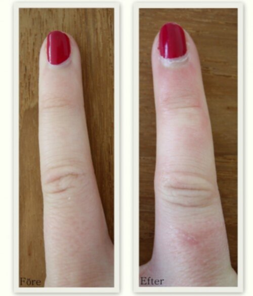 ont i fingret svullet ont i fingret svullet